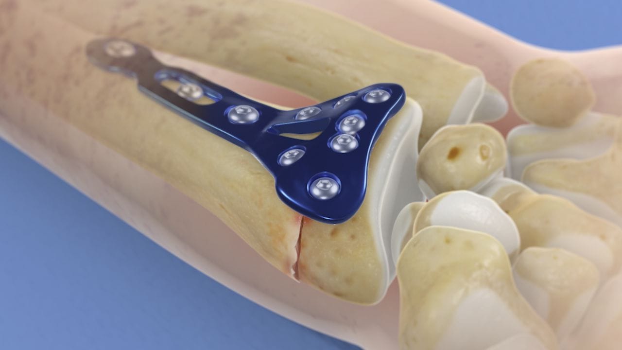 Plate Removal Surgery: When Is Hand Plate Removal Surgery Needed?  