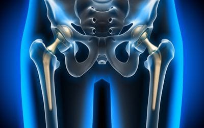  Hip Replacement: How a 28-Year-Old Walked Again Without Pain 