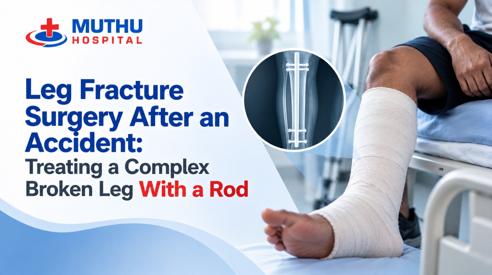 Leg Fracture Surgery After an Accident: Treating a Complex Broken Leg With a Rod